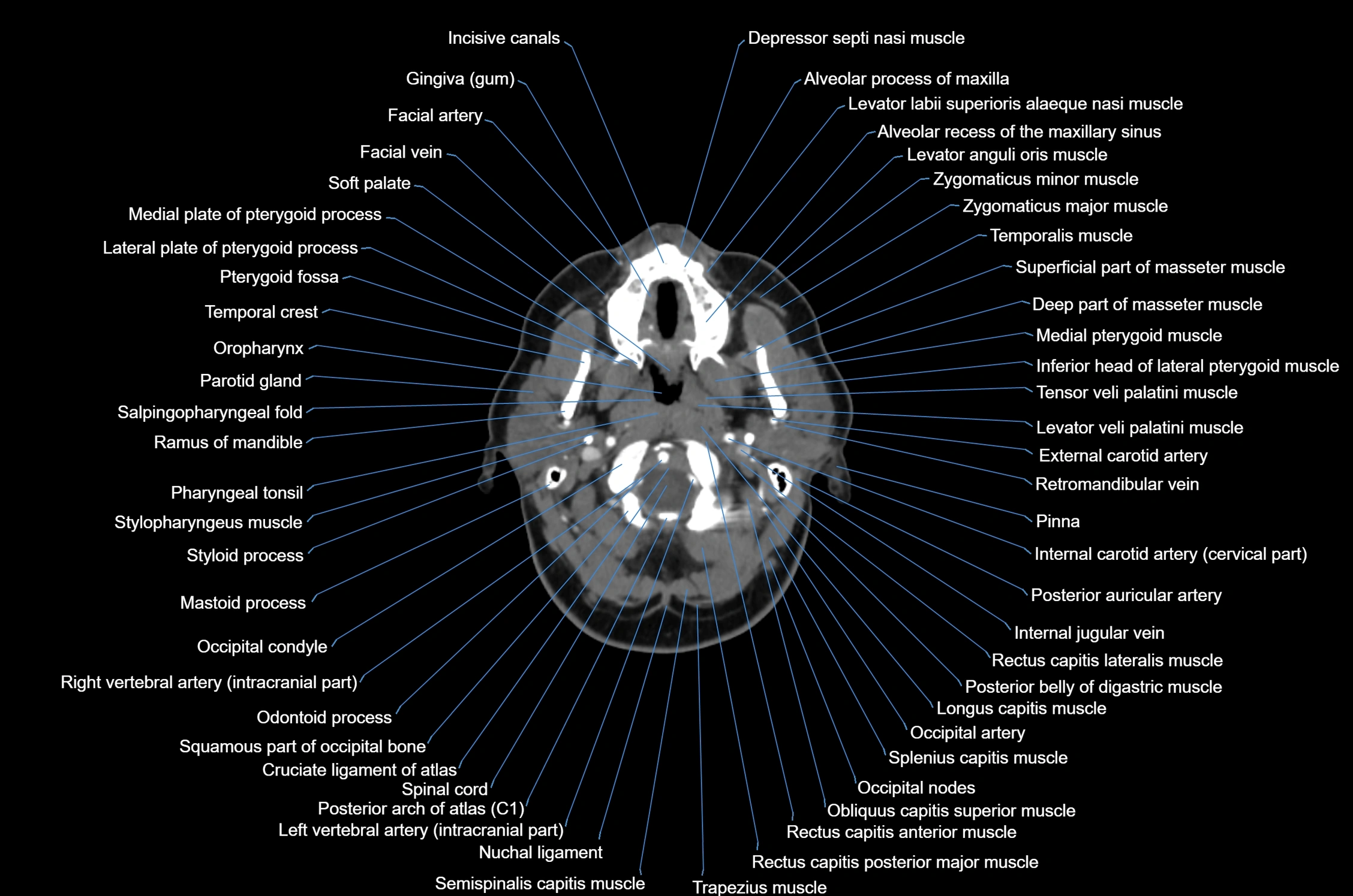 CT Neck axial cross sectional anatomy radiology image-img-00001-00021.webp
